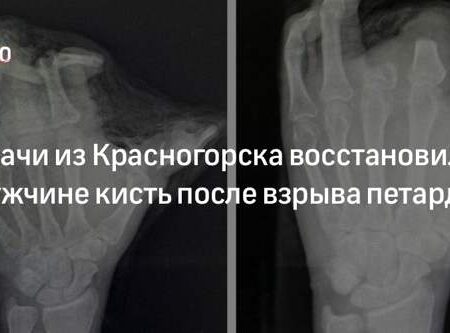 Уникальная операция: врачи восстановили ладонь мужчине после взрыва петарды