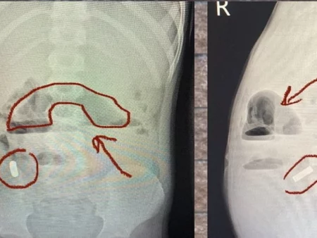 Срочная операция: Из кишечника подростка удалили до 100 магнитов