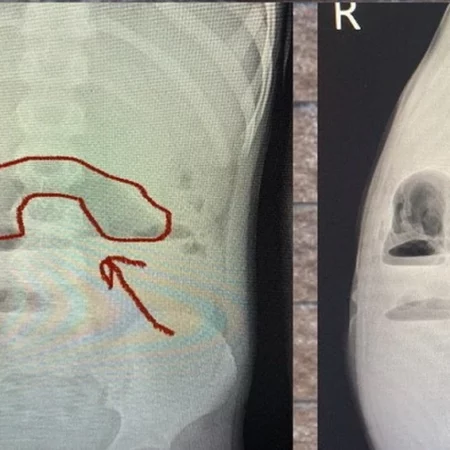 Срочная операция: Из кишечника подростка удалили до 100 магнитов
