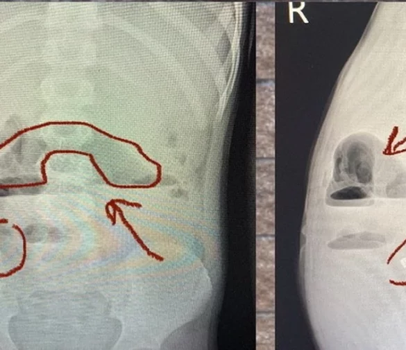 Срочная операция: Из кишечника подростка удалили до 100 магнитов